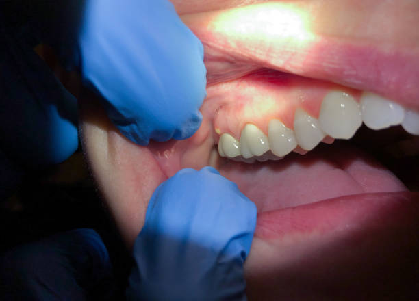 Best Emergency Root Canal Treatment in Johnstonville, CA